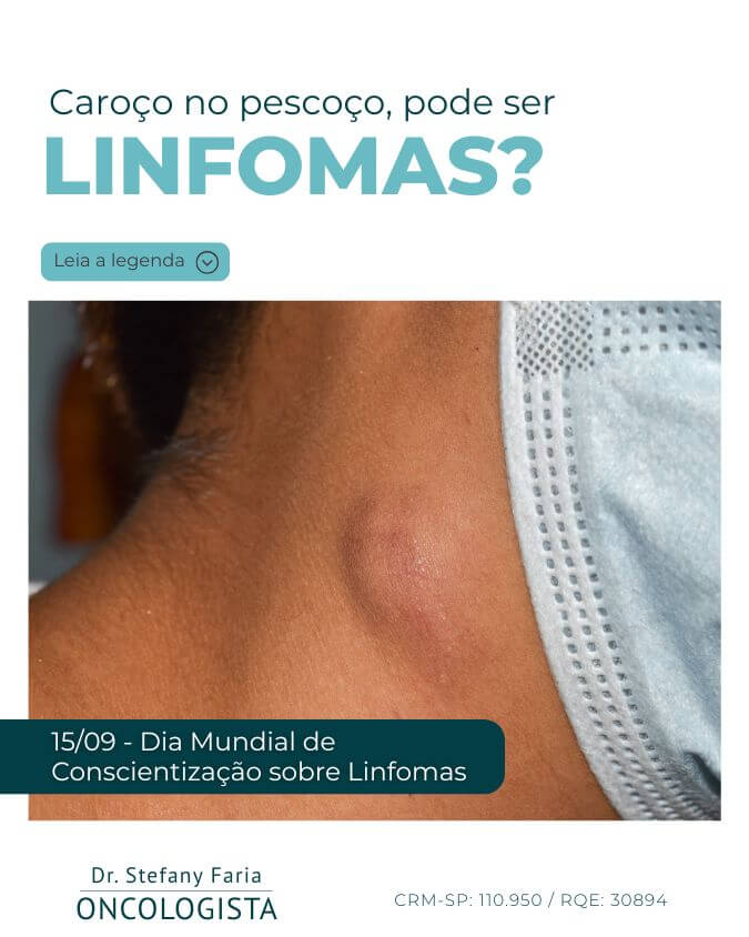 Caroço no pescoço, pode ser linfomas